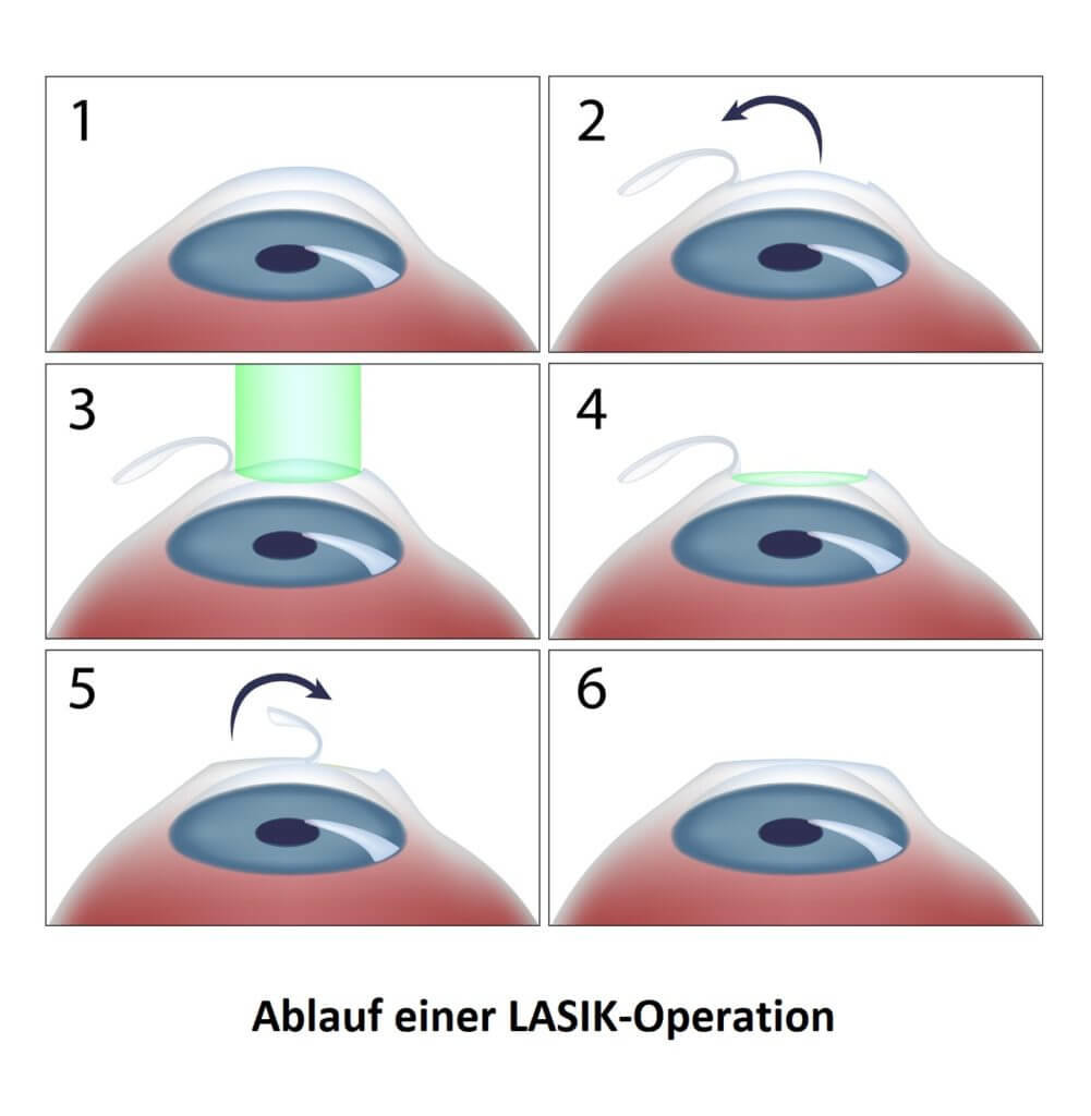 Infografik - Ablauf einer LASIK-Operation