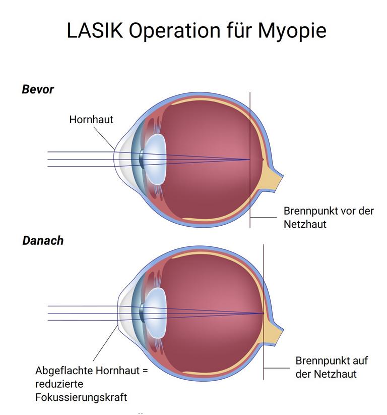 LASIK Operation für Myopie_Kurzsichtigkeit